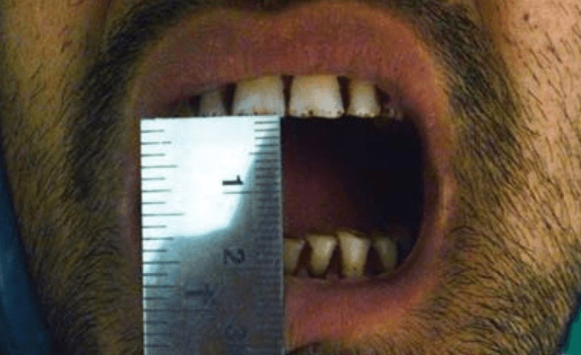 Teeth Measuring With Steel Scale for Oral Submucous Fibrosis