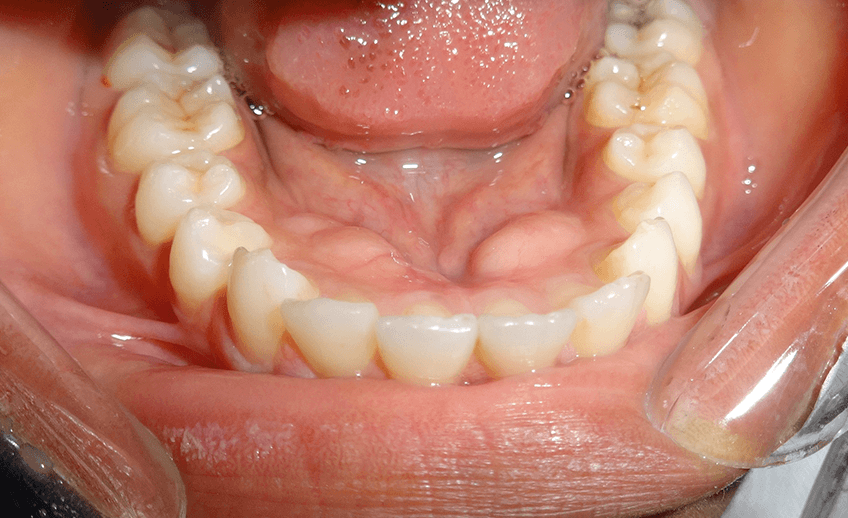Teeth with Pre-prosthetic Surgery