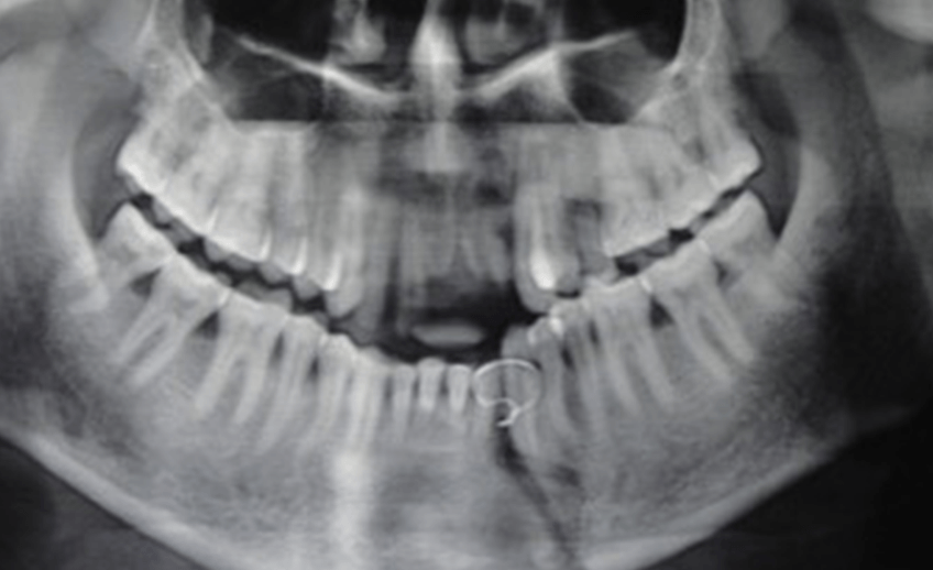 Maxillofacial fractures X-ray