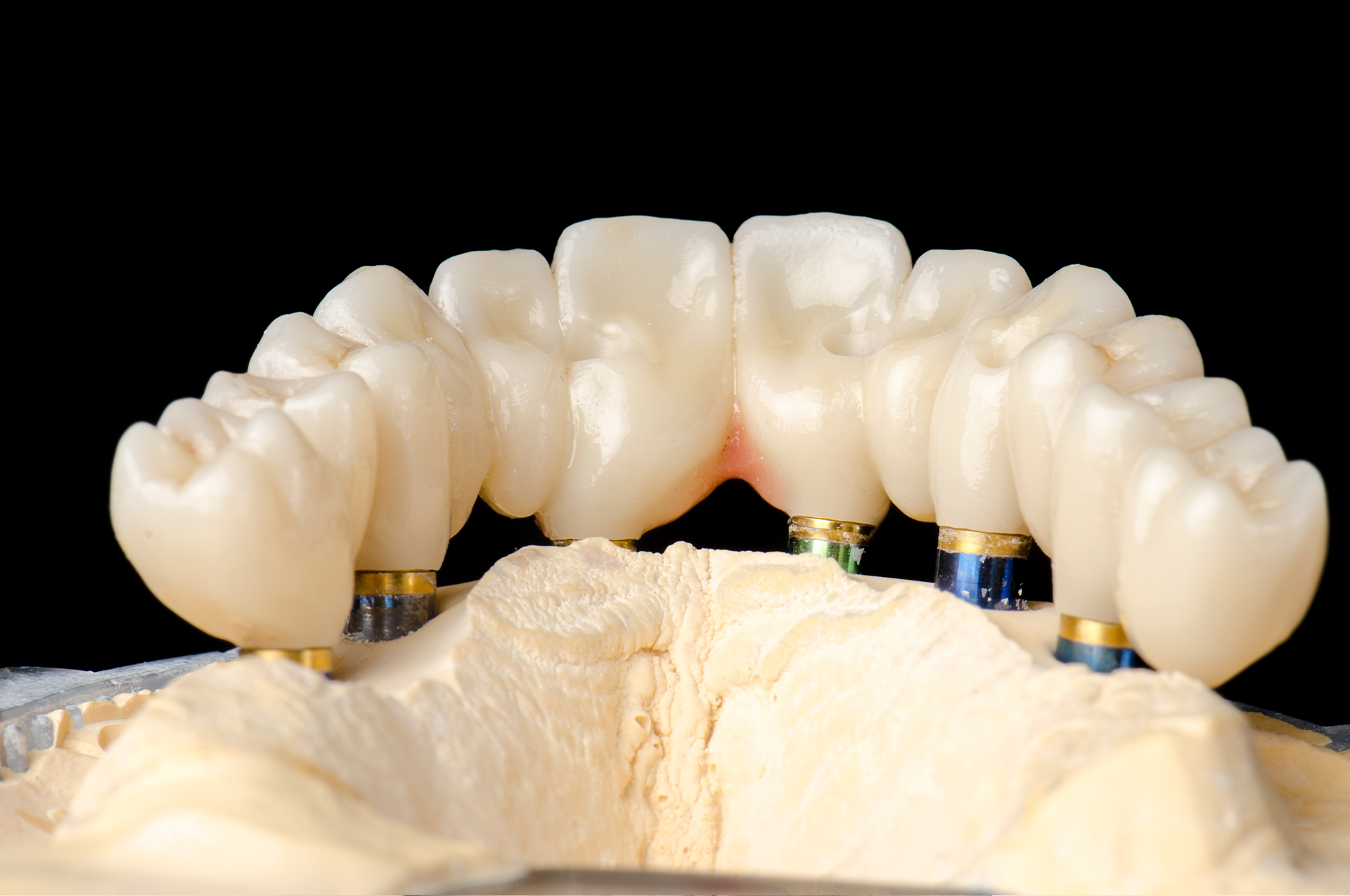 Dental Implants clinic in south mumbai