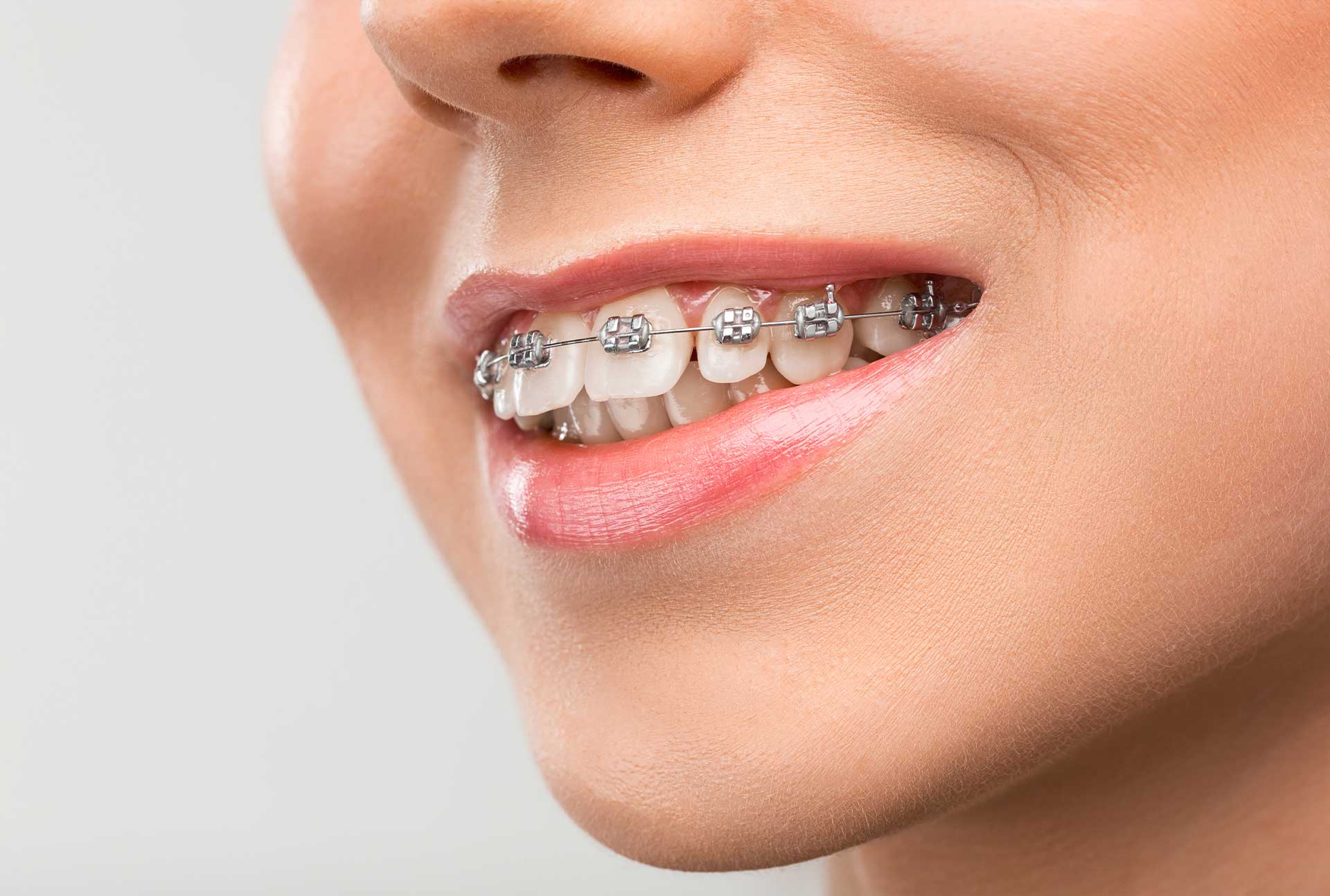Advanced Dental Care Clinic in Grant Road for Braces Treatment