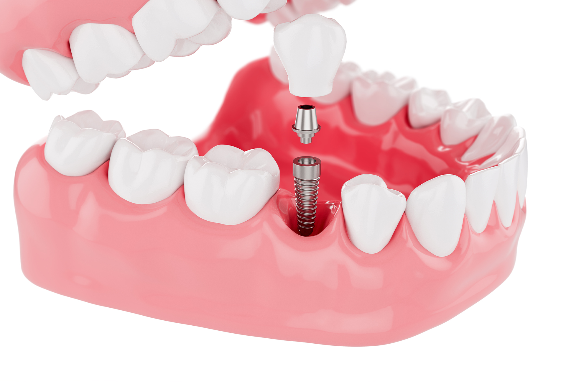 Best Option for Dental Implants in Grant Road, South Mumbai