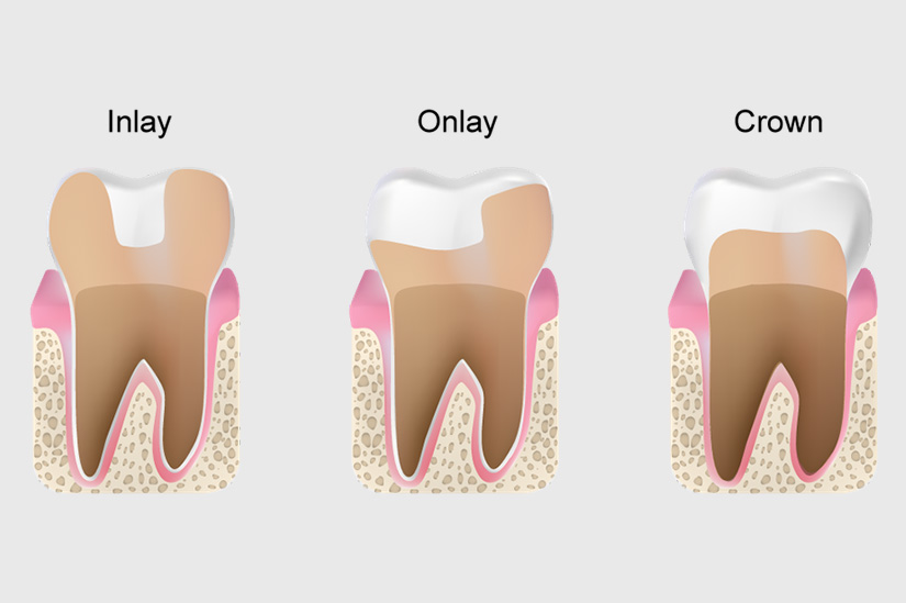 Three images - Inlay, Onlay and Crown