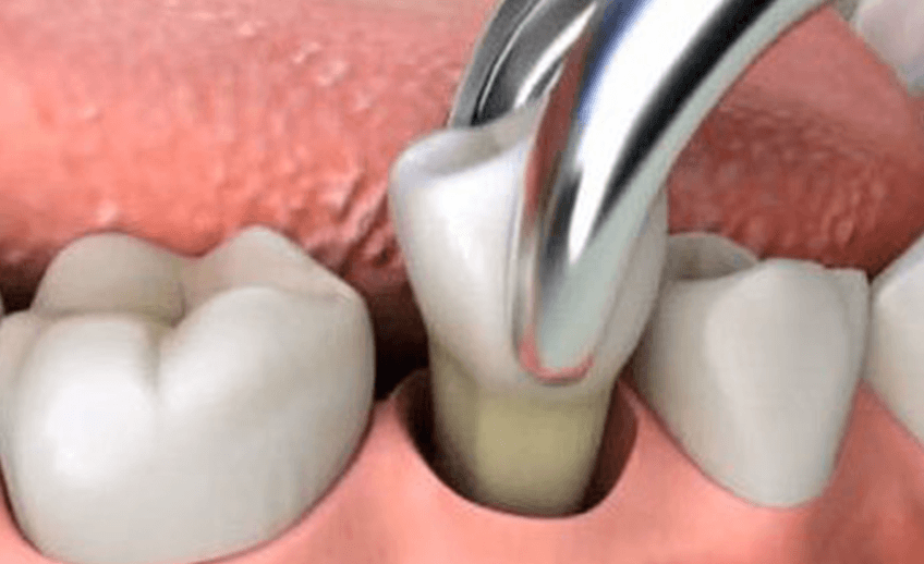 Dental Extractions