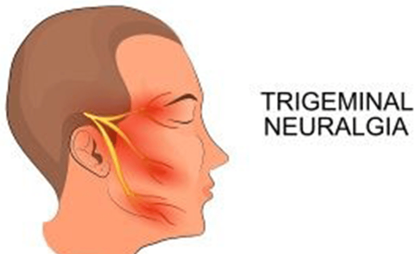 Trigeminal Neuralgia