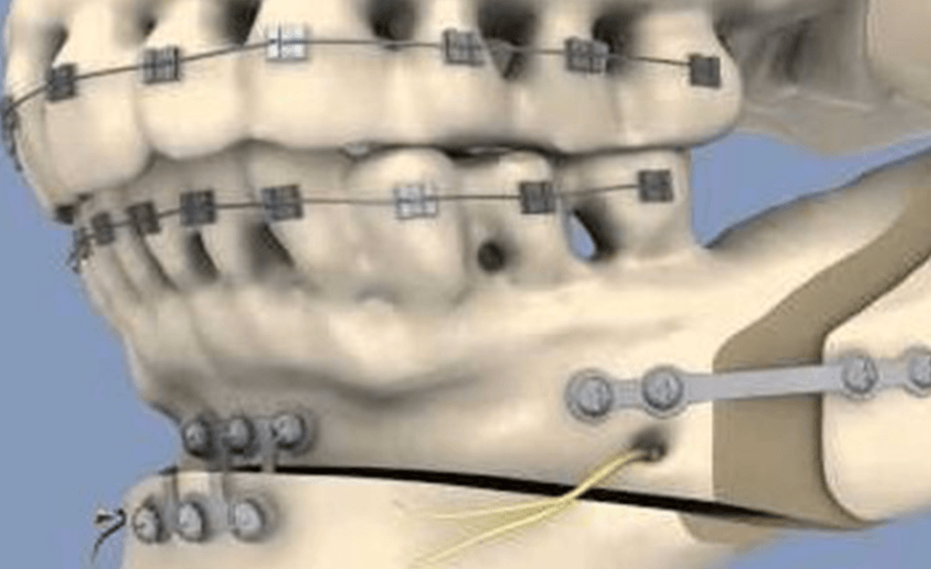 Alignment of the face and jaws using Orthognathic Surgeries