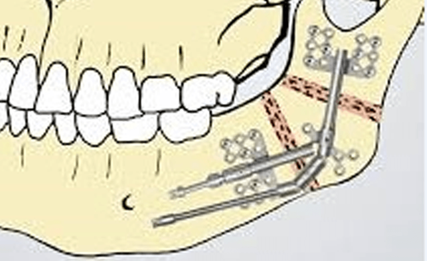 Generating new bone after making a corticotomy using Distraction Osteogenesis method