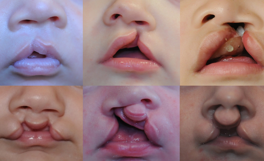 Various Images for Cleft Lip and Palate Surgeries
