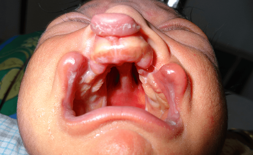 Cleft Lip and Palate