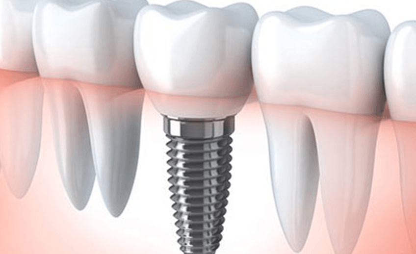 Image for Dental Implants