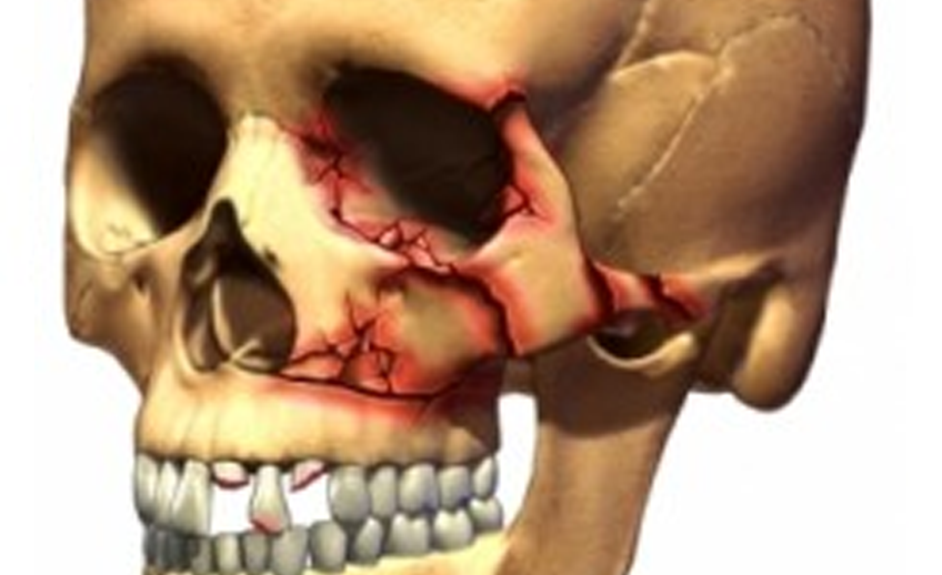 Skeleton Image for Maxillofacial fracture