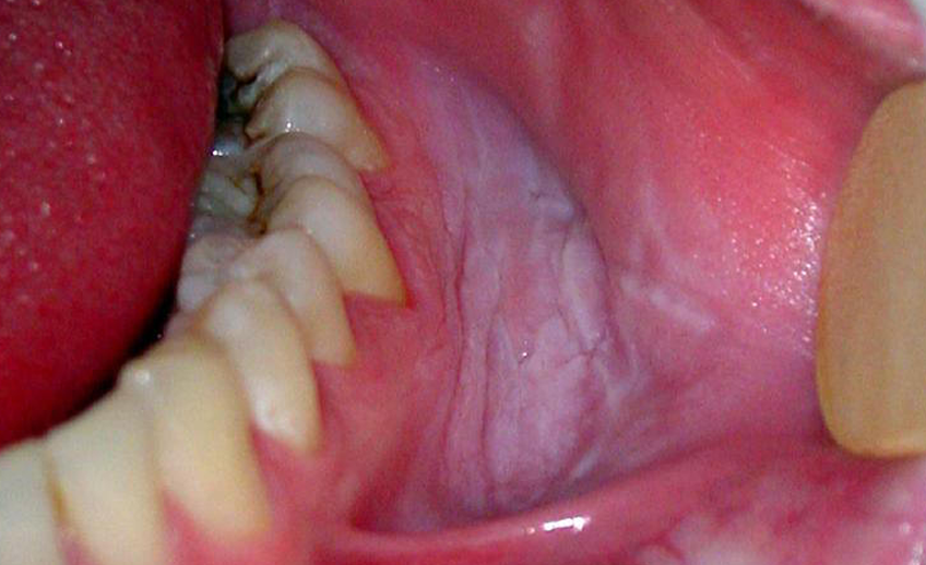 Red and White Lesions of The Oral Cavity