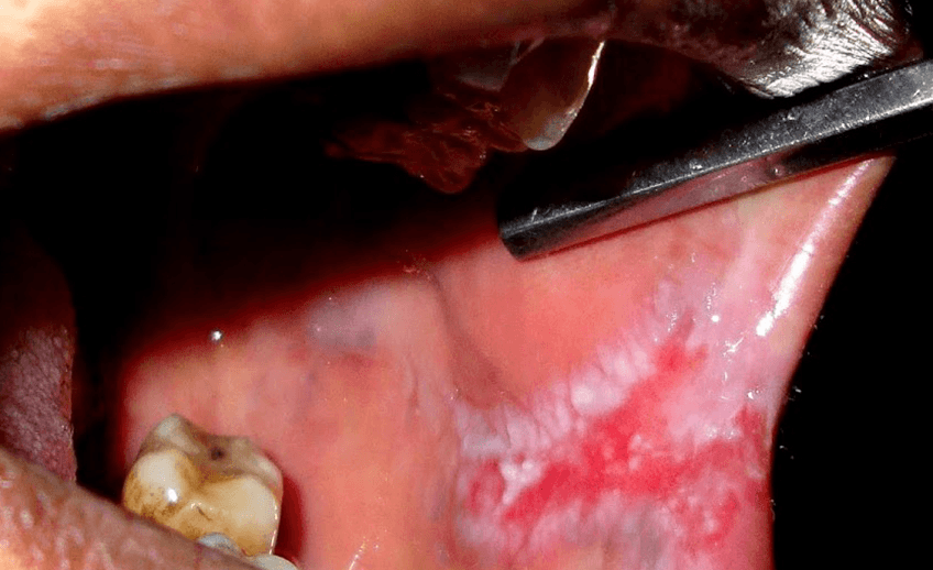 Red and White Lesions of The Oral Cavity