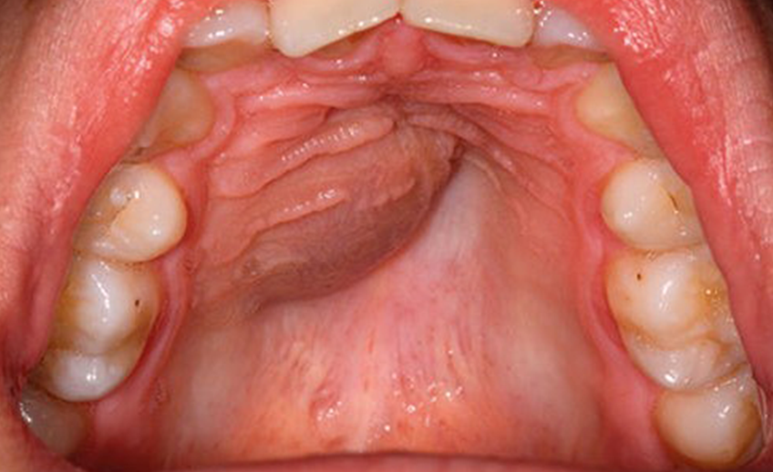 Maxillofacial Cysts and Non-Malignant Tumours